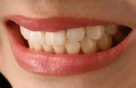 The Benefits of Barrow Composite Bonding: Affordable and Non-Invasive Dental Treatment for Cosmetic Improvements