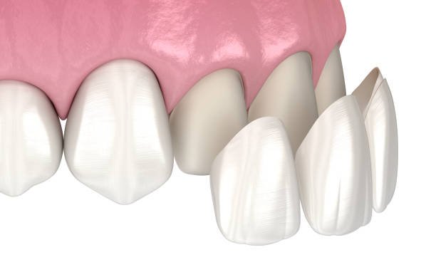 Composite Bonding 101: What Is It and How Does It Work in Barrow?