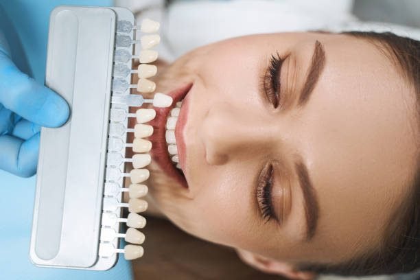 The Complete Guide to Dental Veneers: Everything You Need to Know
