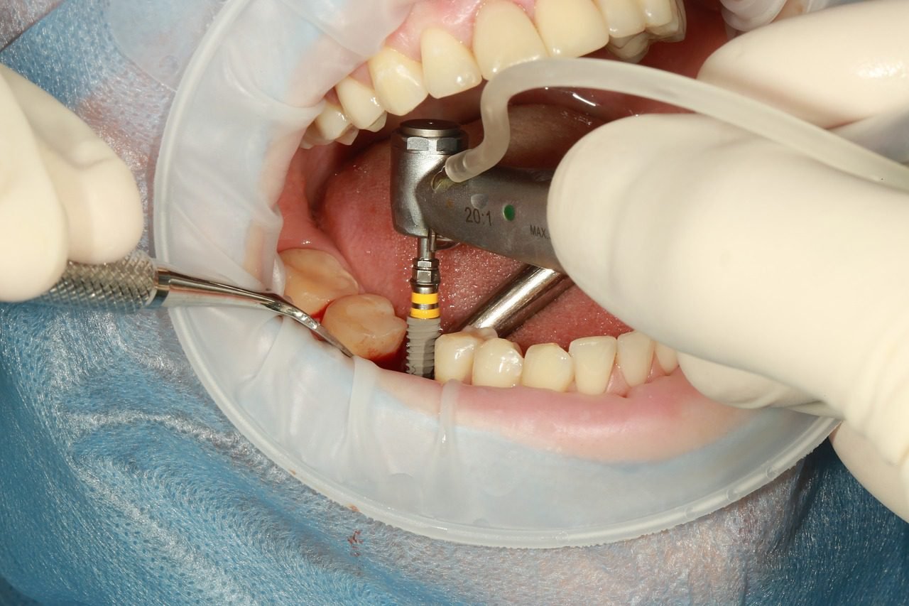 Dental Implant Surgery: What to Expect and How to Prepare