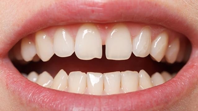 Composite Bonding