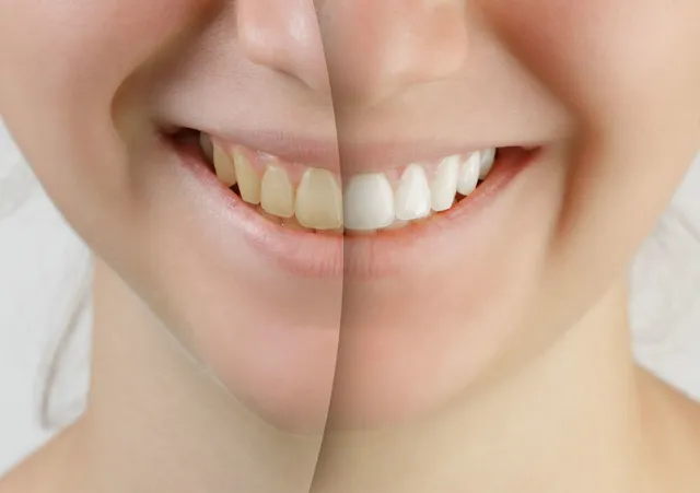 teeth whitening