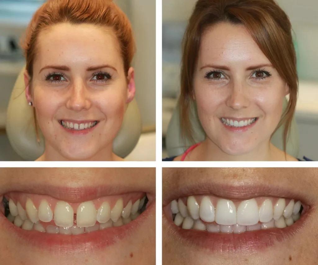 Composite Bonding