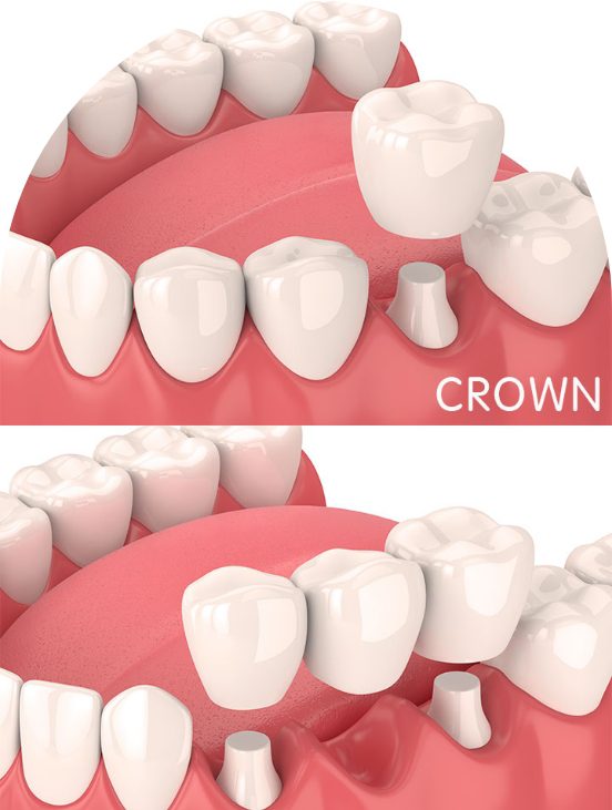 Best Crown & Bridges