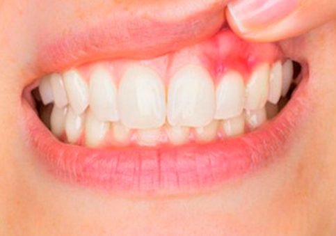 Best Gum Lift Treatment